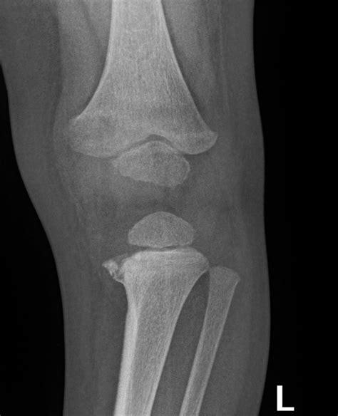 Proximal Tibial Fractures - Don't Forget the Bubbles