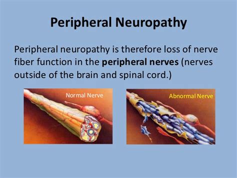 Peripheral Neuropathy: Causes, Symptoms & Remedies | IYTmed.com