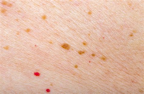 Red Spots On Skin Skin Spots Red Skin Spots Cherry An - vrogue.co