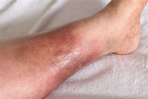 Here’s What You Should Know About Cellulitis | Banner Health