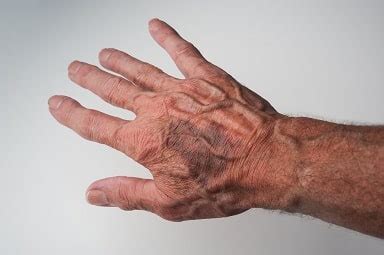 Collapsed Vein | Symptoms, Causes, Treatments, And Prevention