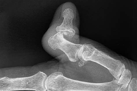 SPRAIN, THUMB INTERPHALANGEAL (IP) JOINT | Hand Surgery Source