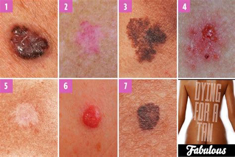 Can You Spot Which Moles Are Deadly? The Skin Cancer Signs You Need To CED