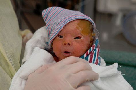 Harlequin Ichthyosis, a severe genetic disorder that mainly affects the skin. Infants with this ...