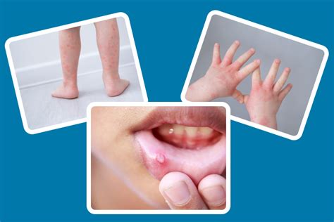 Hand-Foot-And-Mouth Disease: Causes, Symptoms and Treatment - Oris ...