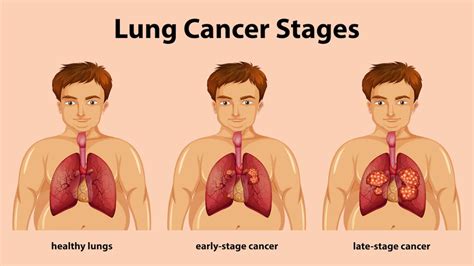 Four Stages Of Lung Cancer Disease Stock Vector Illus - vrogue.co