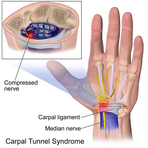 Carpal Tunnel Syndrome Can Be Treated With Chiropractic Care