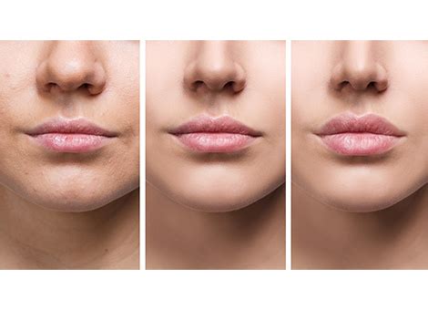 How To Reduce Lips Without Surgery In India | Lipstutorial.org