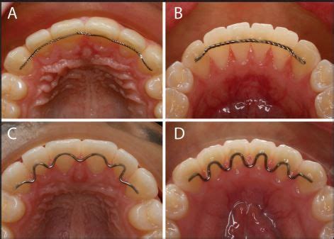 Orthodontic Bonded Retainers | Orthodontics, Permanent retainer, Dental videos