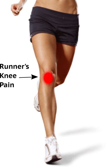 What Is Runner’s Knee? Signs, Symptoms and Rehab Guide | by Alina Kennedy | Medium