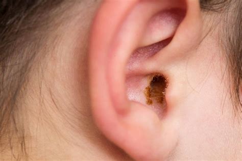 Why Do My Ears Feel Clogged?