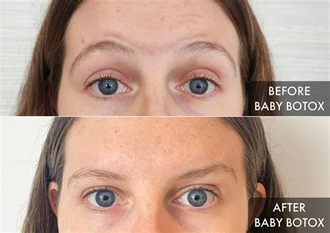 Not Sure When To Get Botox? We Tried Baby Botox For The First Time ...