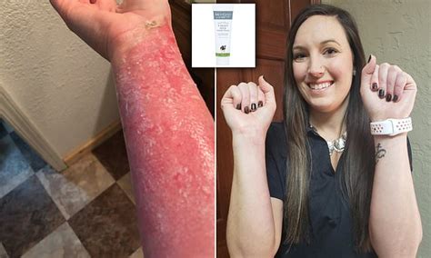 Woman, 28, who suffered severe burns when pressure cooker exploded, has been healed by £8 MILK ...