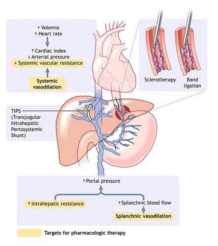 TIPSS For Portal Hypertension Treatment in Mumbai | ID: 7982984348