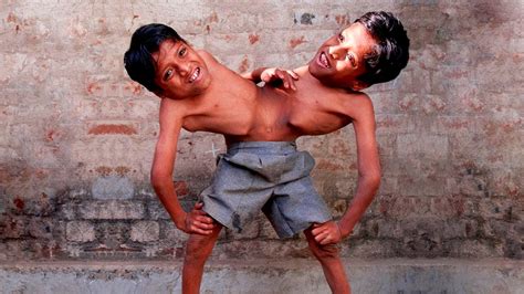 UNUSUAL Conjoined Twins You Won't Believe Exist - YouTube