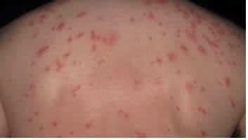 Salmonella Symptoms Rash