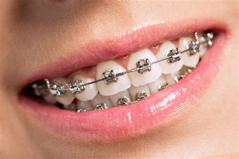 Background Of Braces - The interesting blog 9457