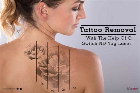 Tattoo Removal With The Help Of Q Switch ND Yag Laser! - By Dr. Malay ...