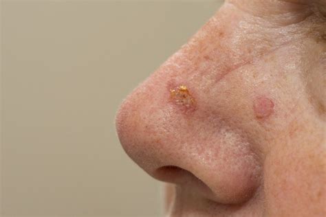 Solar Keratosis: Symptoms, Causes And Complications