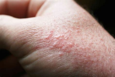 Itchy Skin Rash On Hands