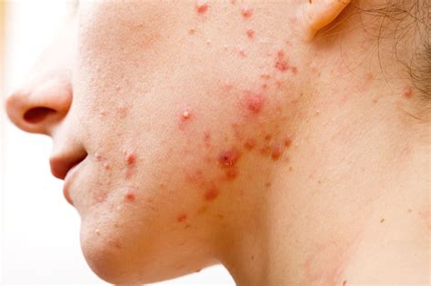 Frustrated by Acne? New Research Shows Skin Microbiome Makes a Difference « Invisiverse ...