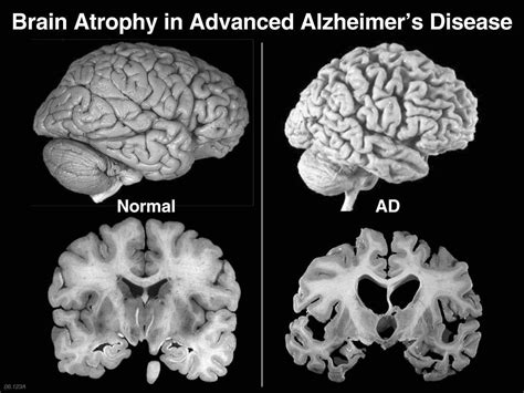 brain atrophy side and front | b-reddy.org