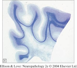 neuropathology blog: What's the deal with the subcortical U-fibers?