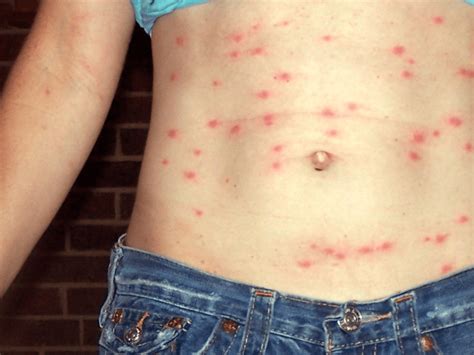 Itchy Bumps On Skin Like Mosquito Bites - Identifying Bug Bites: Here's What Bit You | The Healthy