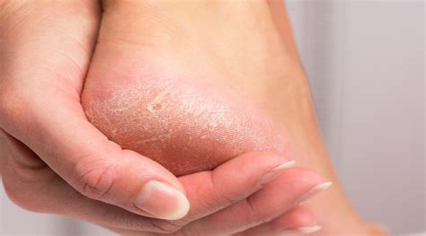 Causes & Treatment for Dry and Cracked Skin | Advanced Foot & Ankle