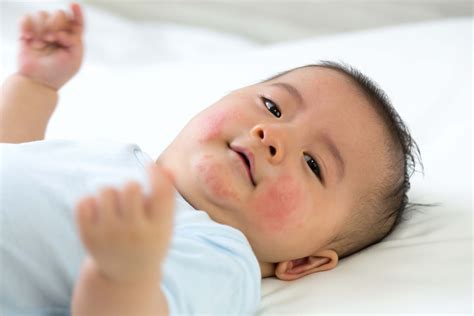 Skin Allergies In Children – Dr. HM Liew Skin Clinic