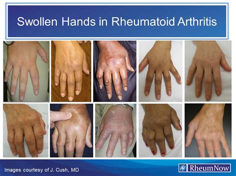 Swollen Hands In Rheumatoid Arthritis | RheumNow