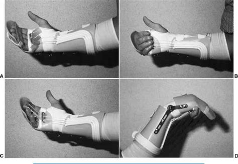 Finger Mp Pip Splints - Extremity Splinting - Mitch Medical