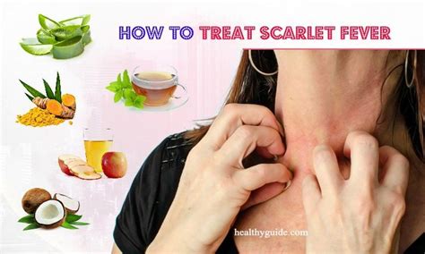 10 Tips How to Treat Scarlet Fever Rash, Itch, Peeling in Babies & Adults