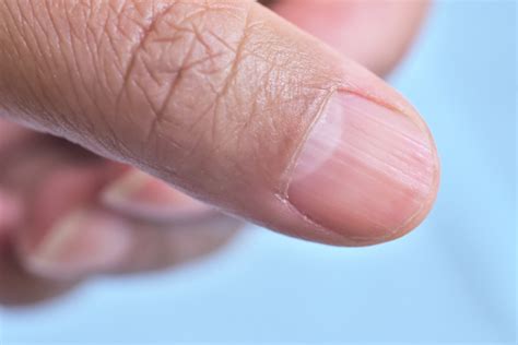 Have Ridges on Your Fingernails? This is What They MeanRateMDs Health News