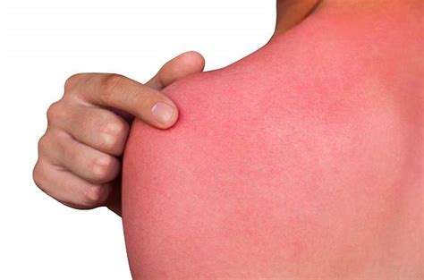 The secret to curing your sunburn is in your fridge | Daily Mail Online