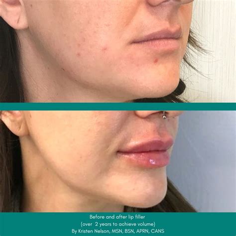 Lip Filler Treatments - Pure Dermatology
