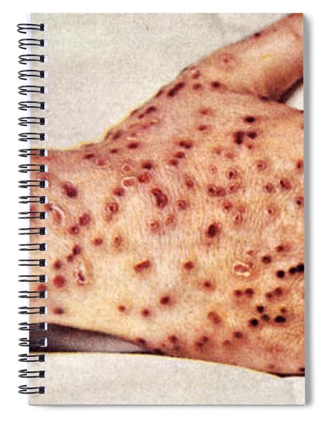 Smallpox Lesions