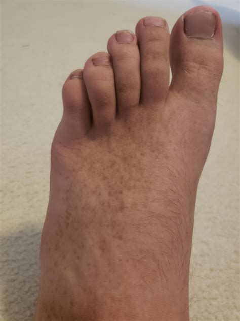 White Spots On Feet