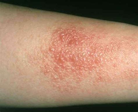 Contact Dermatitis & Allergic Rash Treatment Los Angeles, Skin Allergy Clinic Los Angeles ...