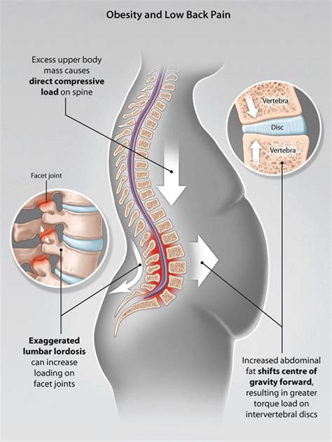 Belly Fat Can Cause Back Pain and Injury - Sciatica Clinic