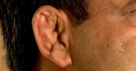 Have You Ever Wondered Why Wrestlers Have Disfigured Ears?