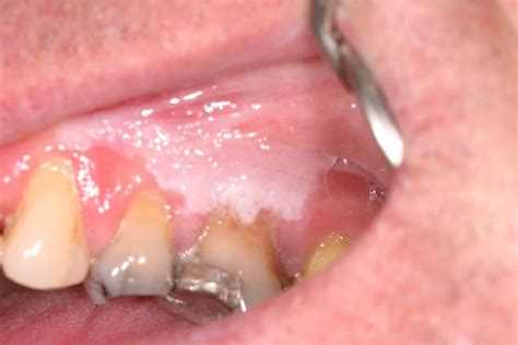 Leukoplakia, Hairy Leukoplakia - Causes, Diagnosis, Treatment