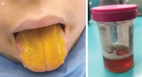 Tongue Icterus, Rare Presentation of Infectious Mononucleosis