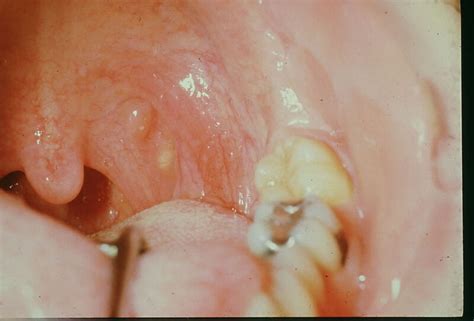 [Figure, Oral lymph-epithelial cyst and aggregate...] - StatPearls - NCBI Bookshelf