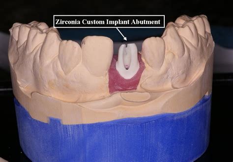 Zirconia Abutment | Ask A Dentist