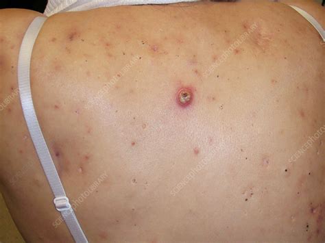 Acne conglobata - Stock Image - C056/5308 - Science Photo Library