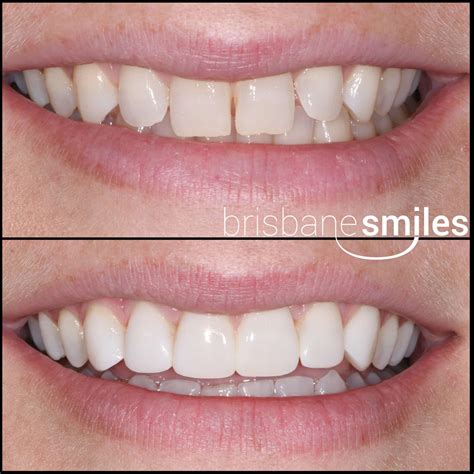 Dental Resin Bonding Photos | Brisbane Smiles