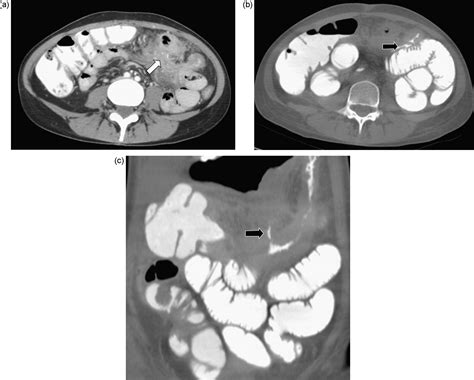 CT enteroclysis in small bowel Crohn's disease - European Journal of Radiology