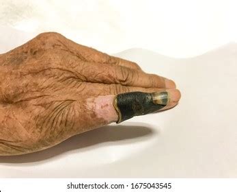 Skin Necrosis Royalty-Free Images, Stock Photos & Pictures | Shutterstock