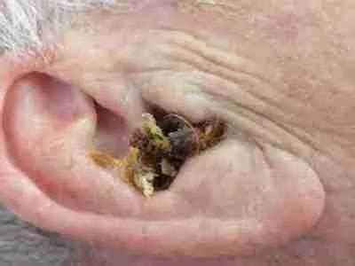 Microsuction Ear Wax Removal Lancing & Sompting - Ear Harmony